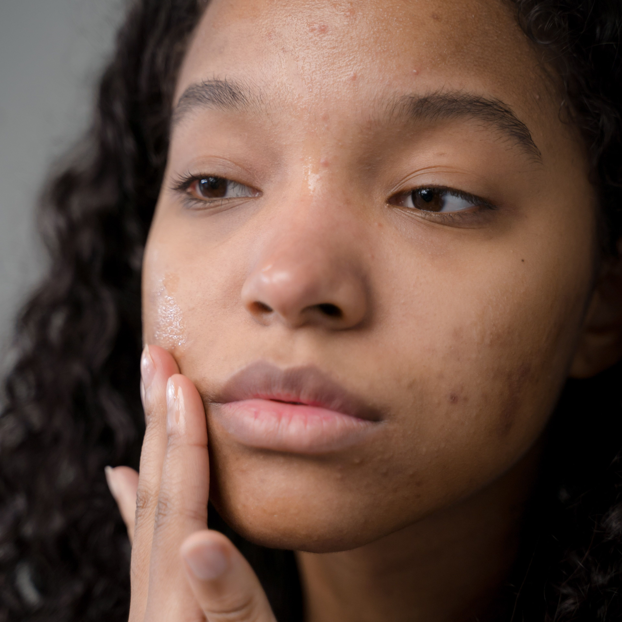 Acne and blemish-prone skin