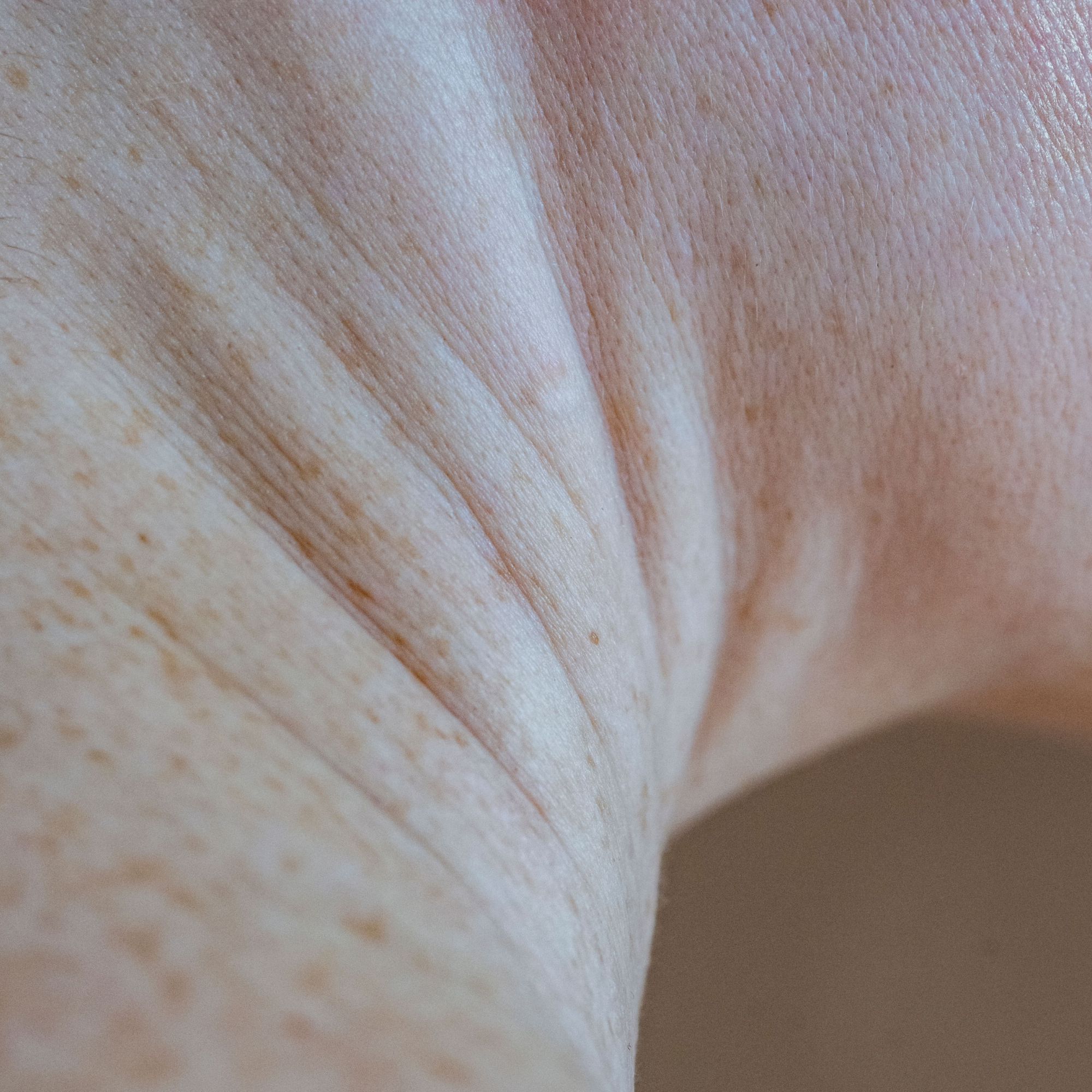 Facial lines and wrinkles